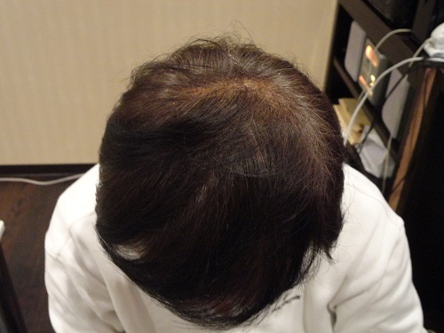 妻に頭頂部の薄さについて指摘をうけ、半ば諦めていました。 AGA治療 After