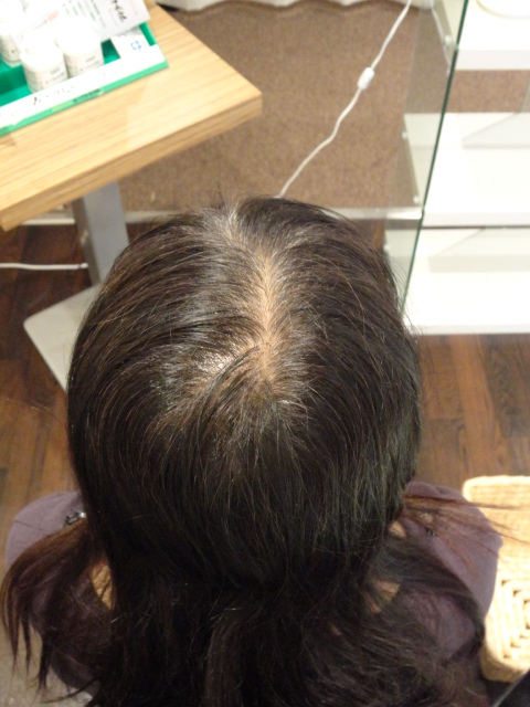 頭頂部から前頭部が透けて見える。髪の毛全体にボリュームダウンしていました。 AGA治療 After