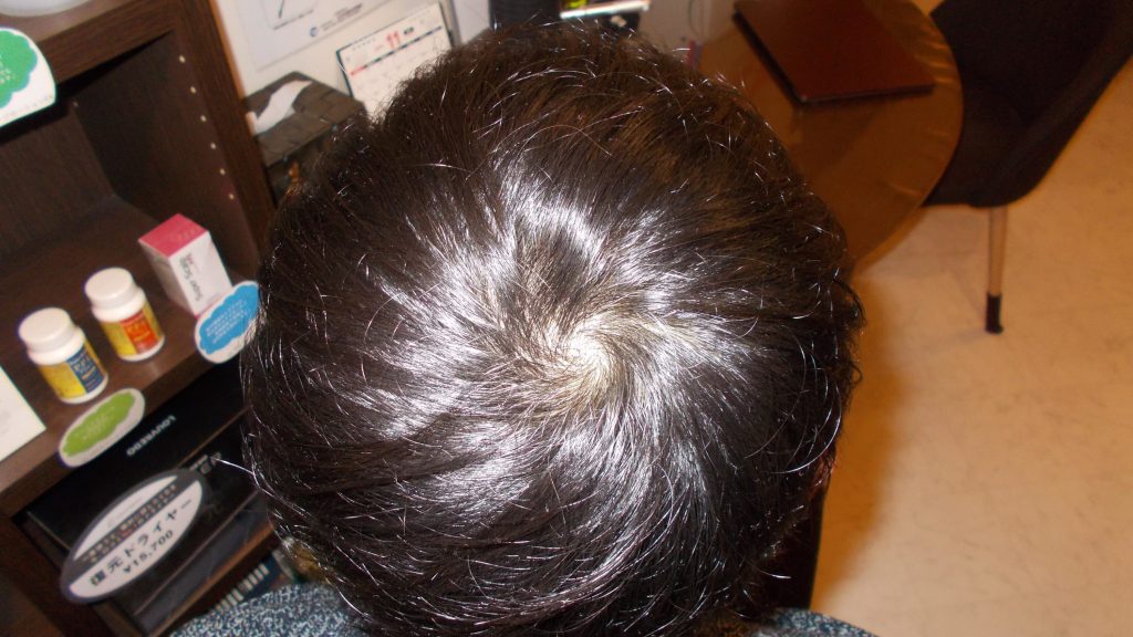 画像で分かる 男性のつむじハゲの基準とは つむじが薄くなる原因と対策は スーパースカルプ発毛センター吉祥寺駅前店