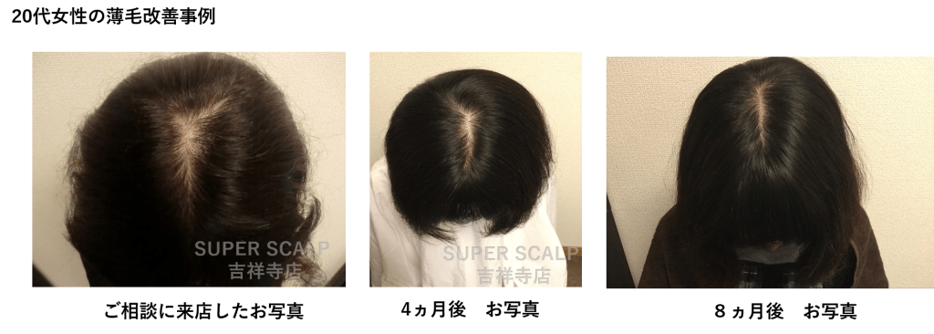 代女性の抜け毛の悩みとは 若いのに髪の毛が抜ける原因と対策法について スーパースカルプ発毛センター吉祥寺駅前店