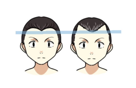 富士額とm字ハゲの違いとは 前髪が富士額だと将来ハゲる確率が高い スーパースカルプ発毛センター吉祥寺駅前店
