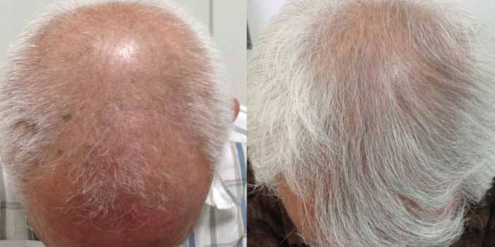 70代男性AGAの発毛症例