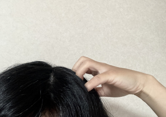 頭皮のかさぶたをはがすと薄毛になる